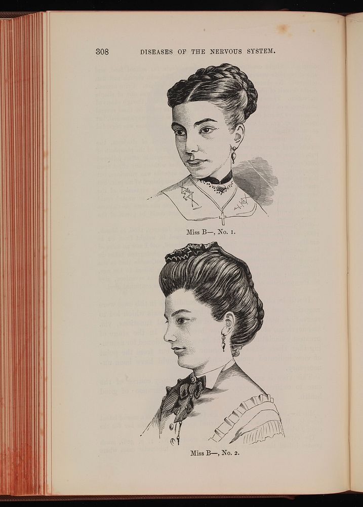 Two woodcuts showing Miss B before and after treatment