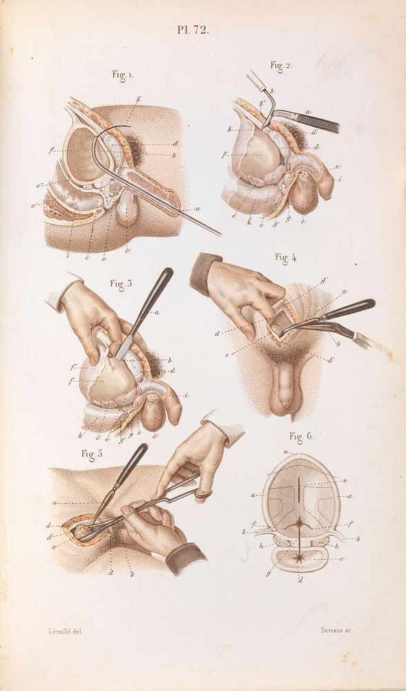 Plate 72, Surgical removal of a stone from the bladder.