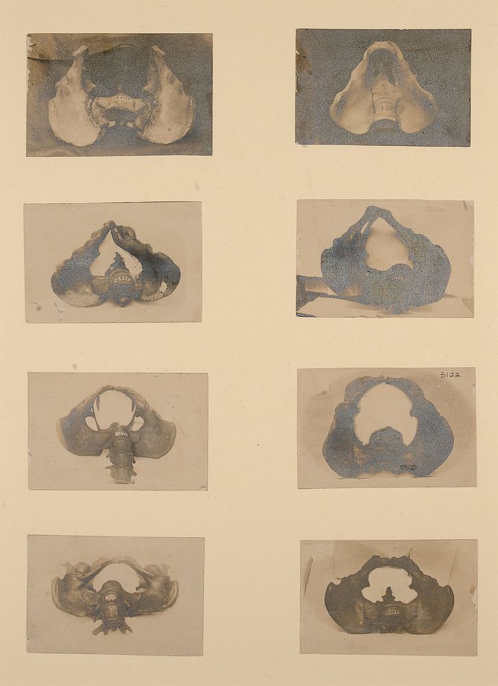 Eight photographs of pelves once held in the St Bartholomew's Hospital Pathology Museum