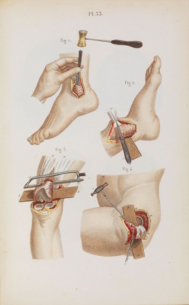 Précis iconographique de médecine opératoire et d'anatomie chirurgicale / [Claude Bernard].