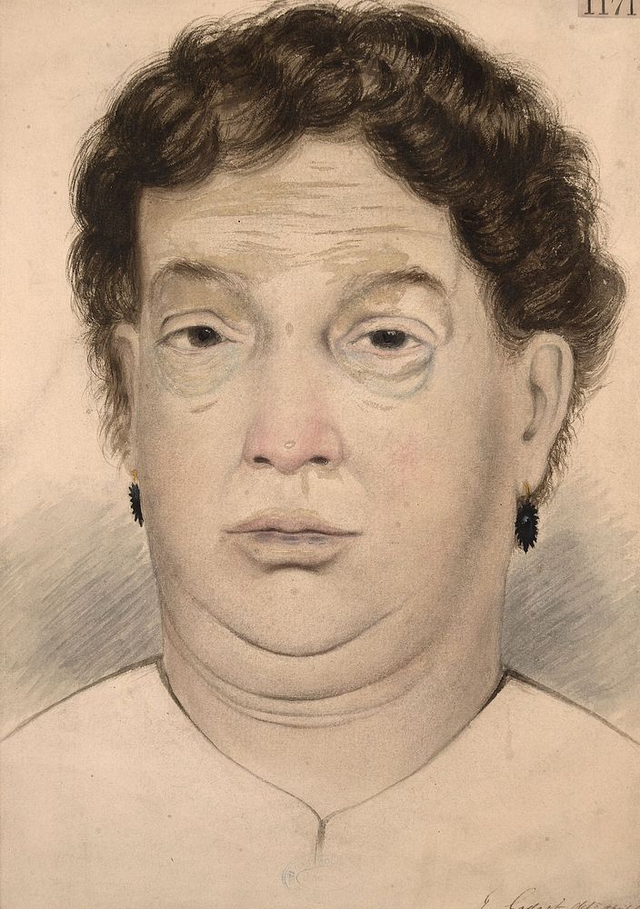 Face of a woman who had been affected with myxoedema for seven years