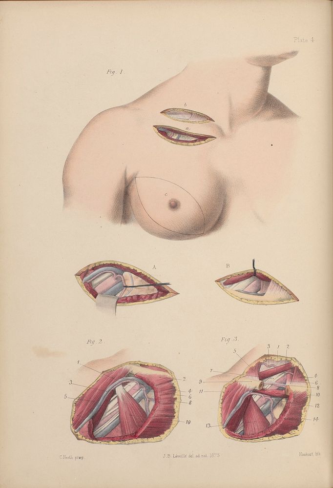 A course of operative surgery / with plates drawn from nature by M. Léveillé and coloured by hand under his direction ; by…
