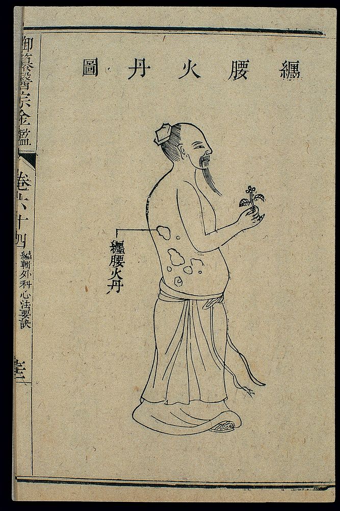 Chinese C18 woodcut: External medicine - Herpes zoster