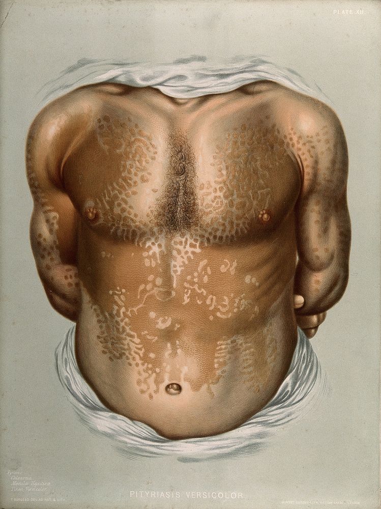 Discoloured skin on the torso and arms of a man suffering from pityriasis versicolor. Chromolithograph by E. Burgess…
