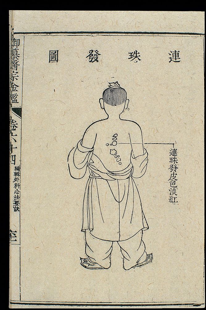 Chinese C18 woodcut: External medicine - 'String of pearls'