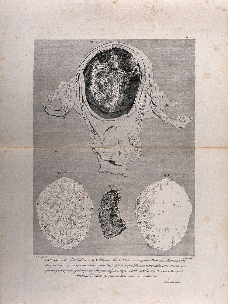 Dissection of the pregnant uterus at six months, showing the placenta and the decidua: four figures. Copperplate engraving…