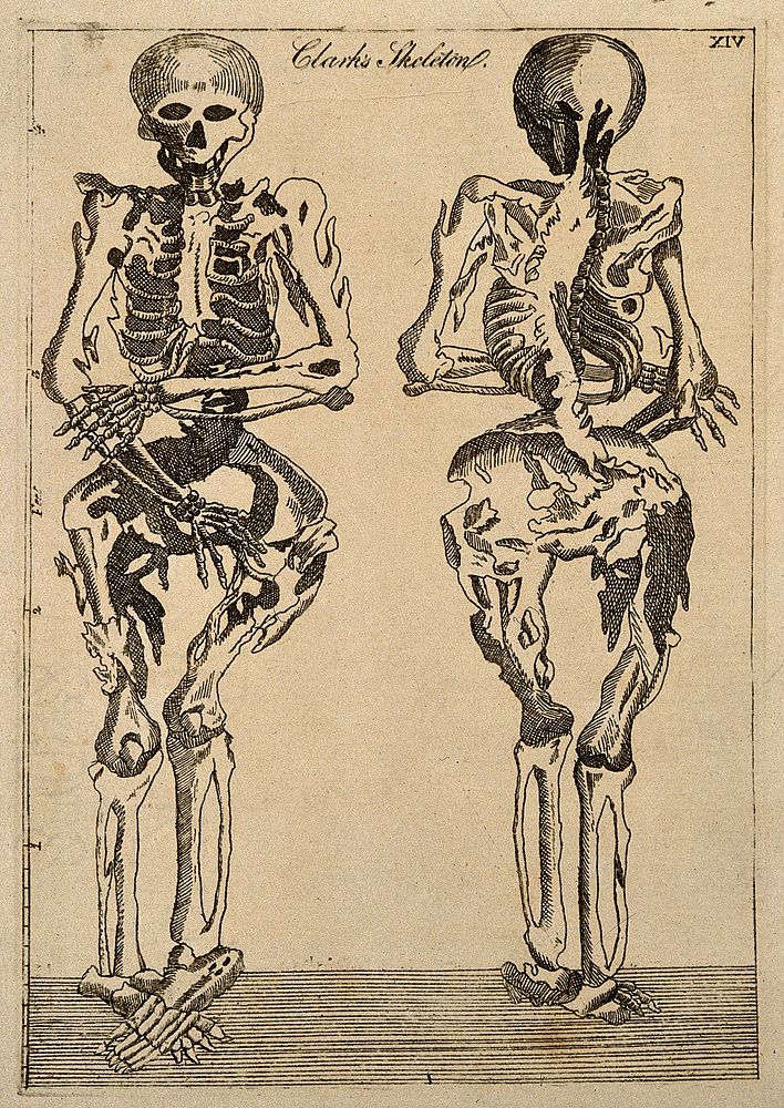 Deformed human skeleton, front and back views. Line engraving ca. 1808.