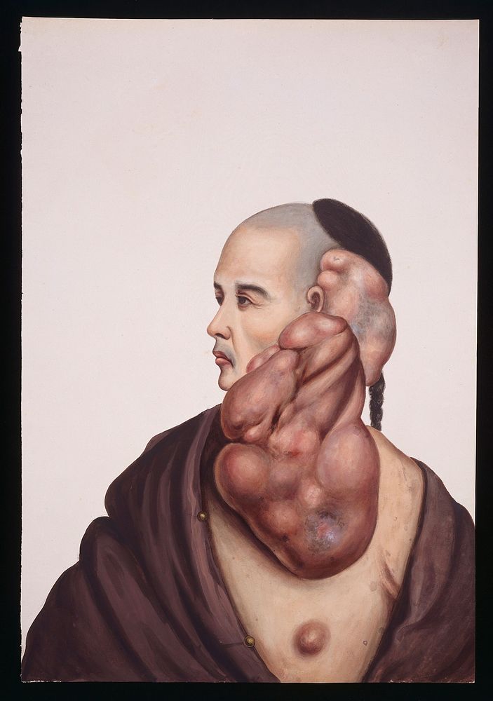 A man (Wan Wakae) with massive pendent tumours on the left side of his face. Gouache, 18--, after Lam Qua, ca. 1838.