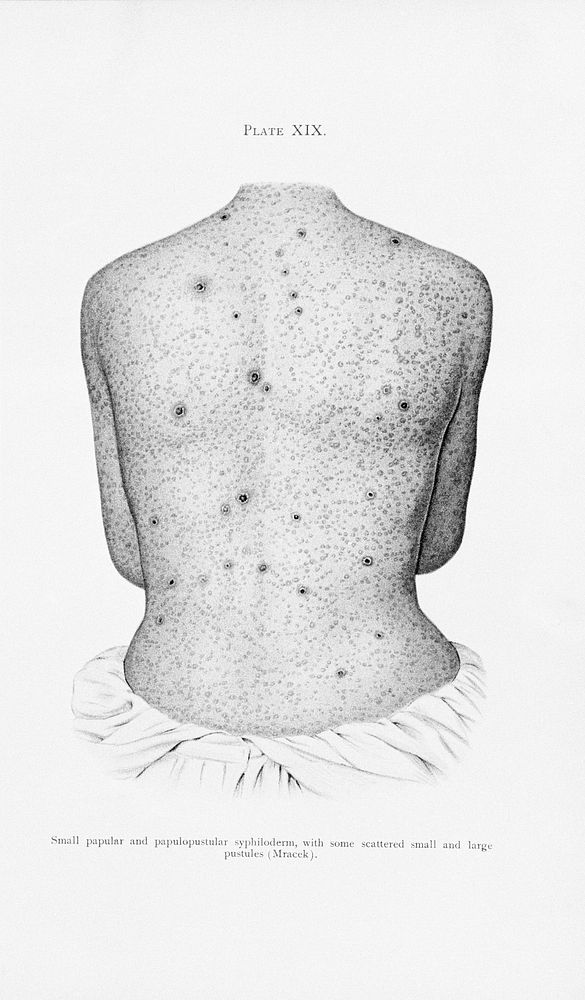 The back of a man suffering from syphilis, showing a rash of papular and papulopustular syphiloderm. Colour lithograph after…