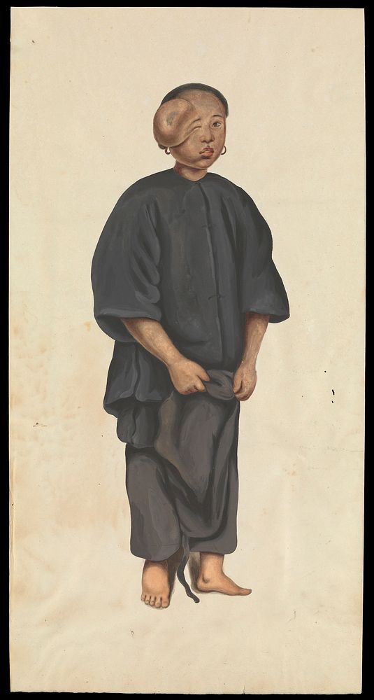 A girl (Akae) with a tumour over her right eye. Gouache, 18--, after Lam Qua, ca. 183-.