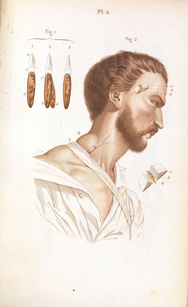 Plate 5, Illustration of lancets and incision points.