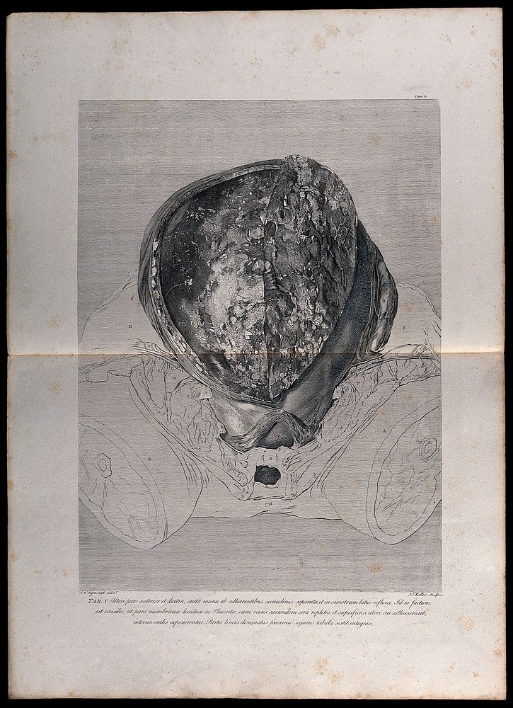 Dissection of the pregnant uterus: initial view of the opened womb. Copperplate engraving by J.S. Müller after I.V. Rymsdyk…
