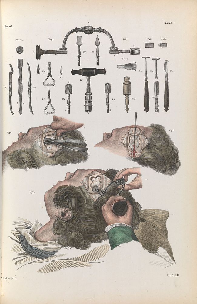 Plate 53. Surgical technique and instruments for trepanation.