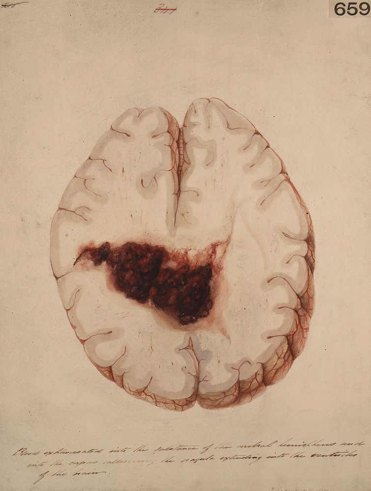 Blood extravasated into the substance of the cerebral hemisphere and into the ventricles of the brain