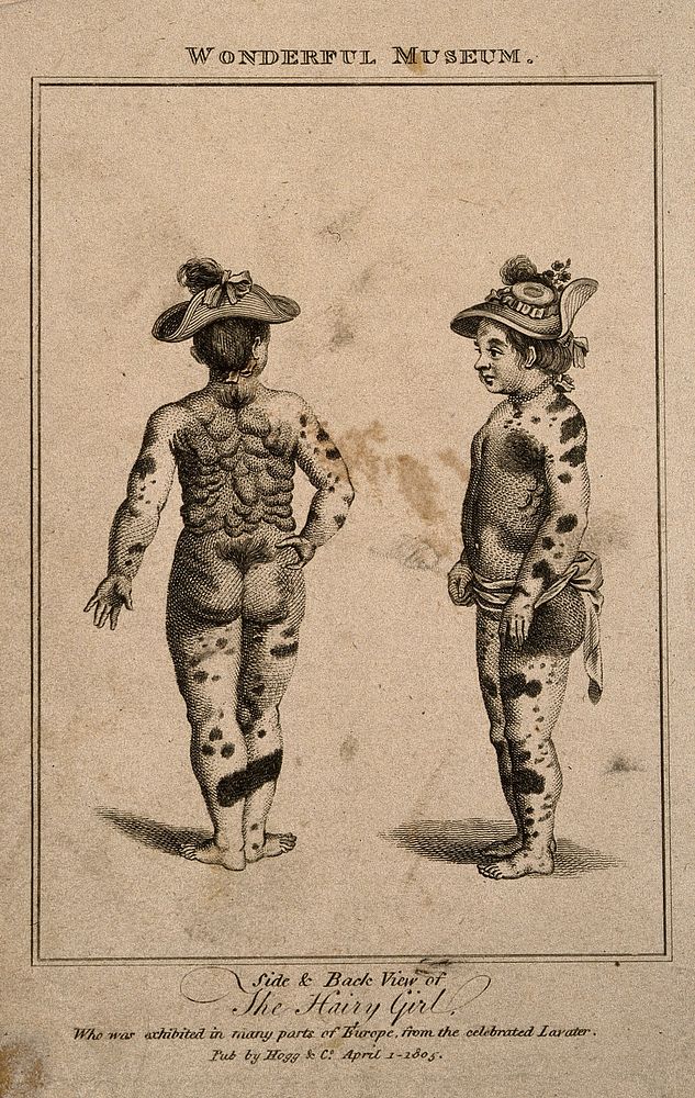 A girl suffering from a skin disease, identified as multiple fibroma: side and posterior view. Engraving, 1805.