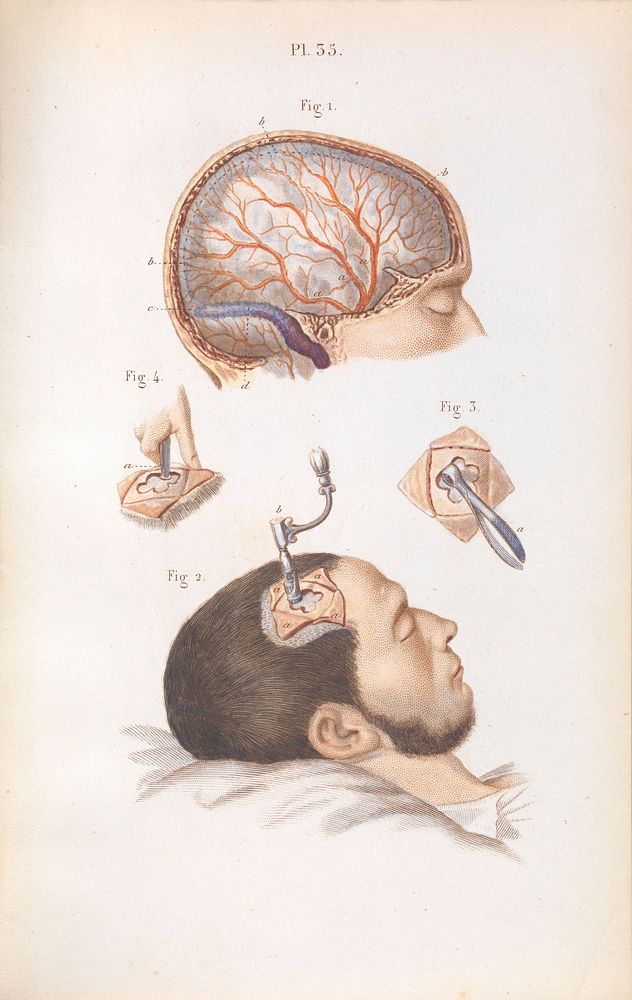 Plate 35, Trepanation of the skull.