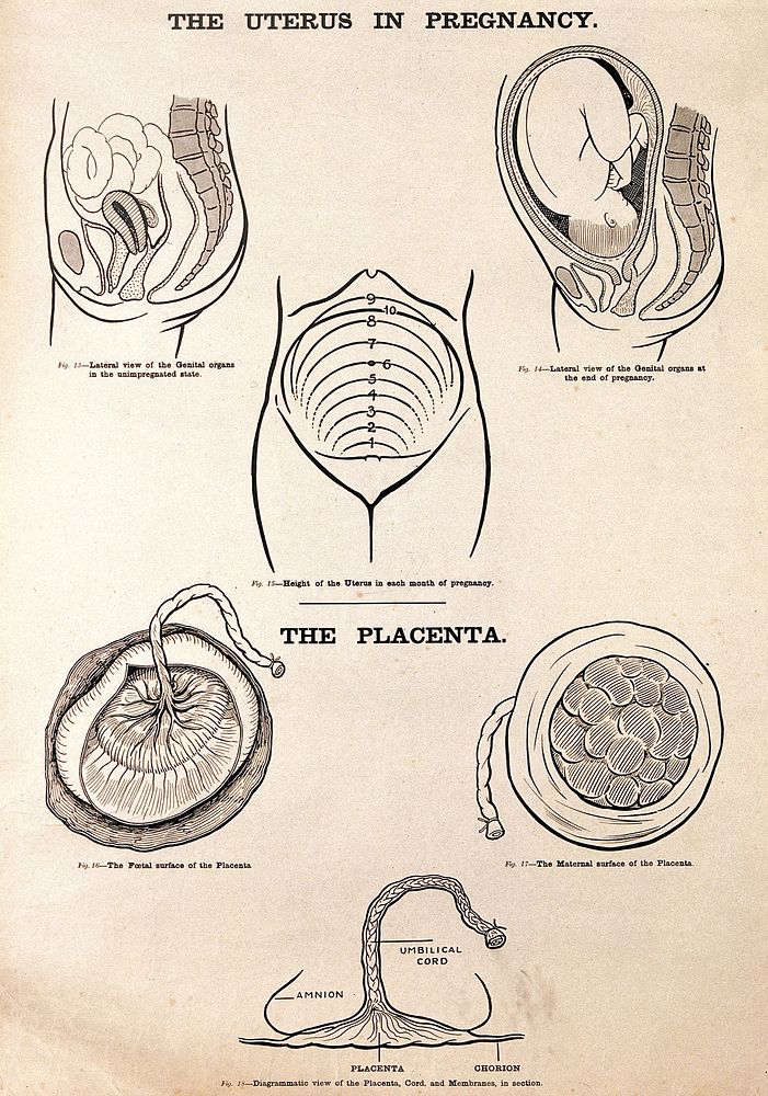 The uterus in pregnancy, and the placenta. Lithograph after W. F. Victor Bonney.