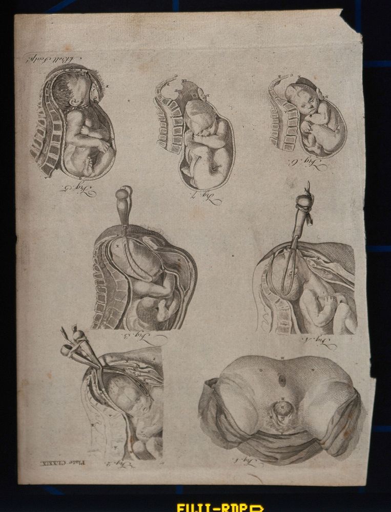Five diagrams illustrating the birth of a child with the use of forceps. Engraving by A. Bell.