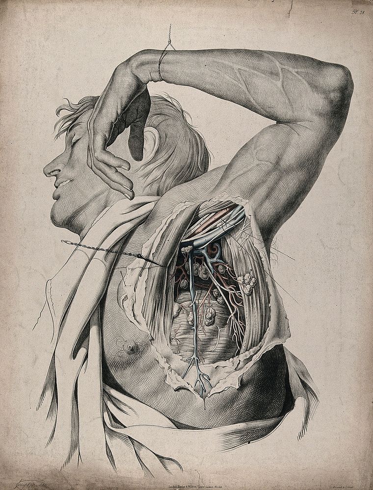 The circulatory system: dissection of the armpit of a man, showing the musculature and lymph nodes and with arteries, blood…