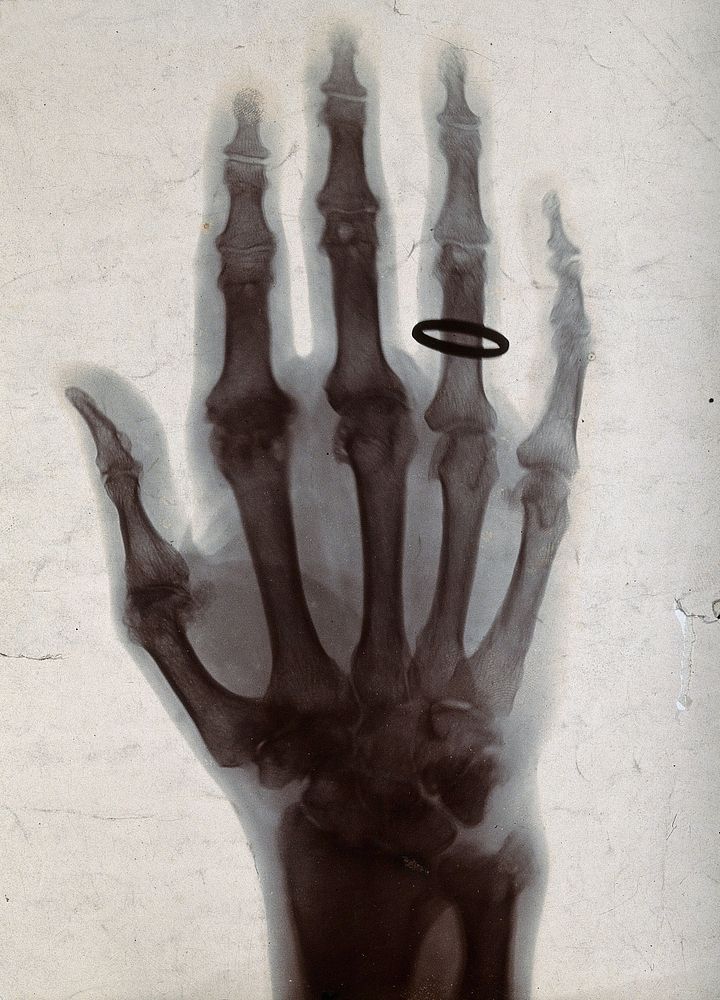 The bones of a hand, with a ring on one finger, viewed through x-ray. Photoprint from radiograph after Sir Arthur Schuster…