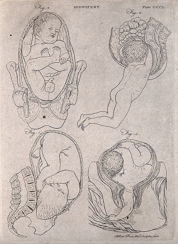 Four diagrams illustrating difficult births. Engraving by A. Bell.