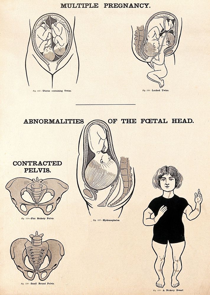 Multiple pregnancy, abnormalities of the foetal head, and contracted pelvis in childbirth. Lithograph after W. F. Victor…