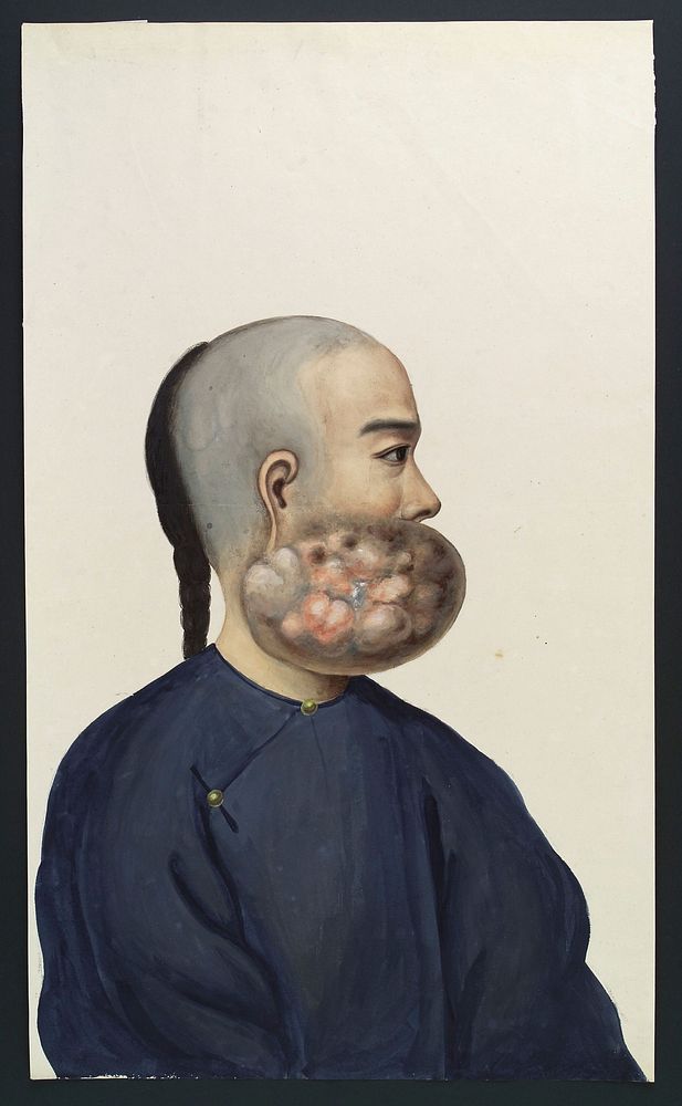 A man (Leang Ashing), in profile, with a tumour on the right side of his face. Gouache, 18--, after Lam Qua, 1837.