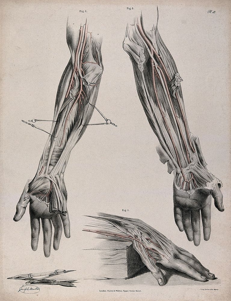 The circulatory system: three dissections of the hand and arm, with arteries and blood vessels indicated in red and surgical…