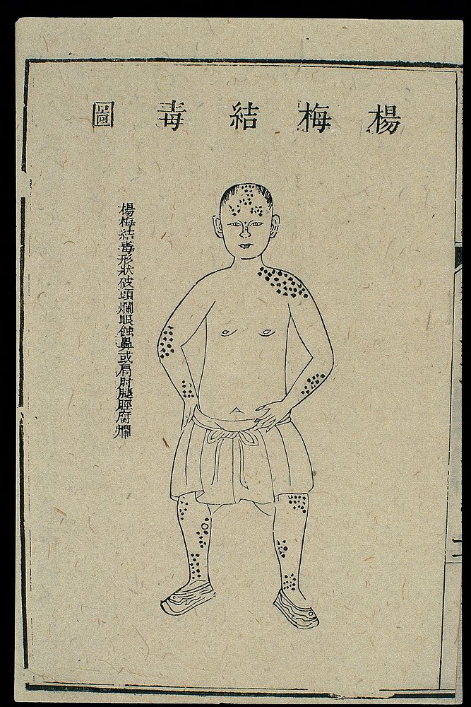 Chinese C18 woodcut: External medicine - syphilitic sores