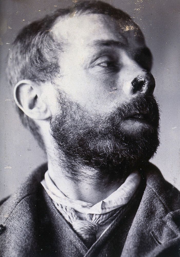Friern Hospital, London: a man's face showing tuberculosis of the skin (lupus vulgaris). Photograph, 1890/1910.