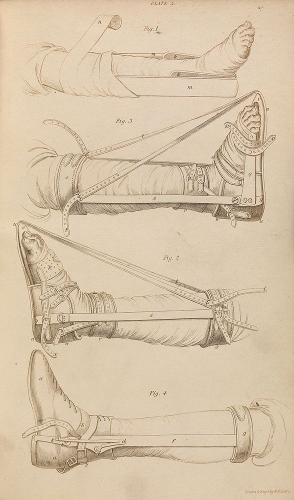 Operation for the cure of clubfoot / illustrated by explanatory plates, the drawings after nature: being an appendix to a…