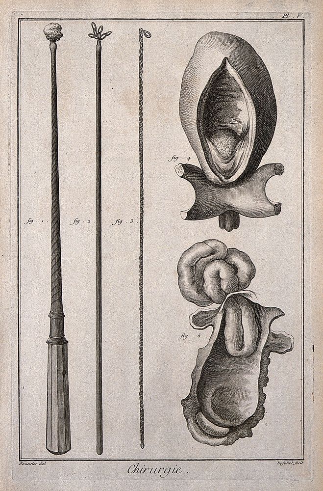 Surgery: Left, surgical instruments to retrieve foreign objects from the oesophagus; right, a bladder with a bladderstone…