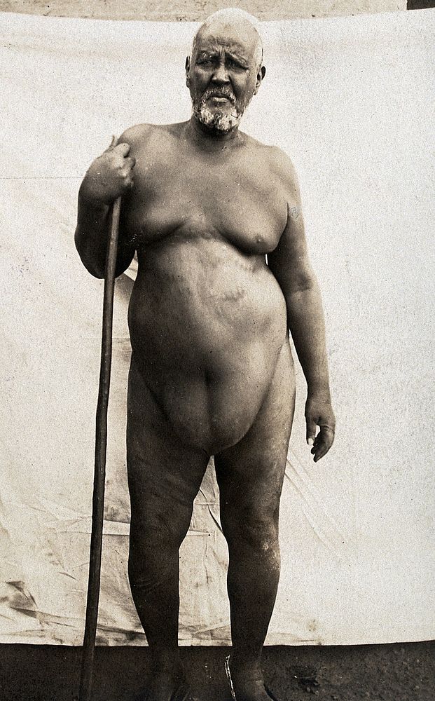 A grey-haired African man, with an stomach oedema. Photograph, ca.1900.