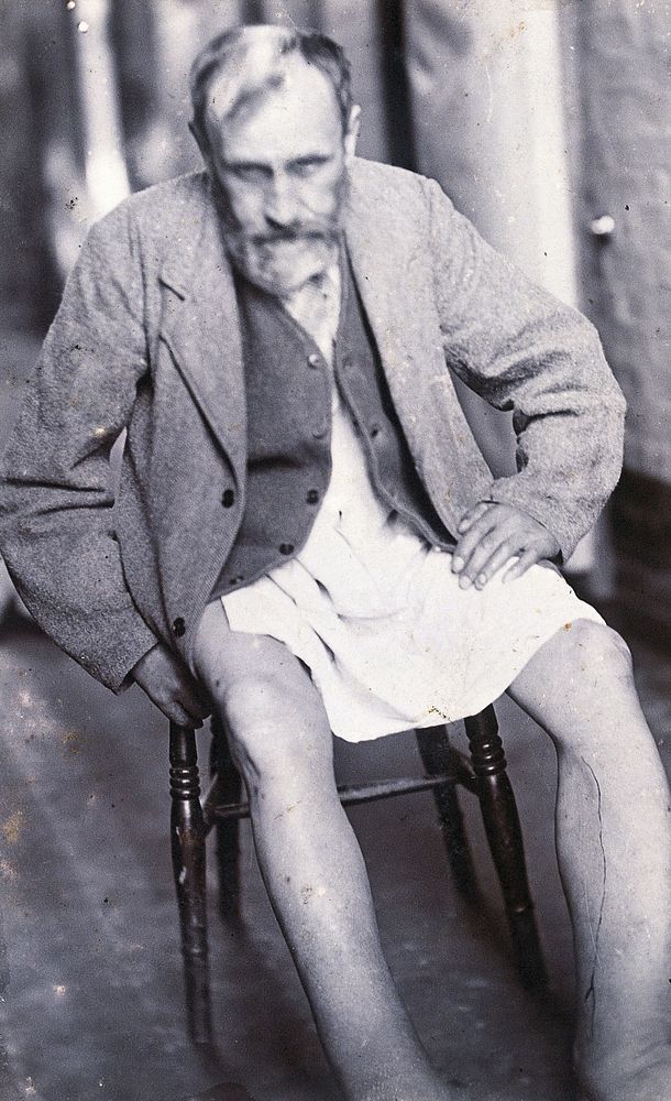 Friern Hospital, London: a male patient, seated, with swollen lower legs. Photograph, 1890/1910.