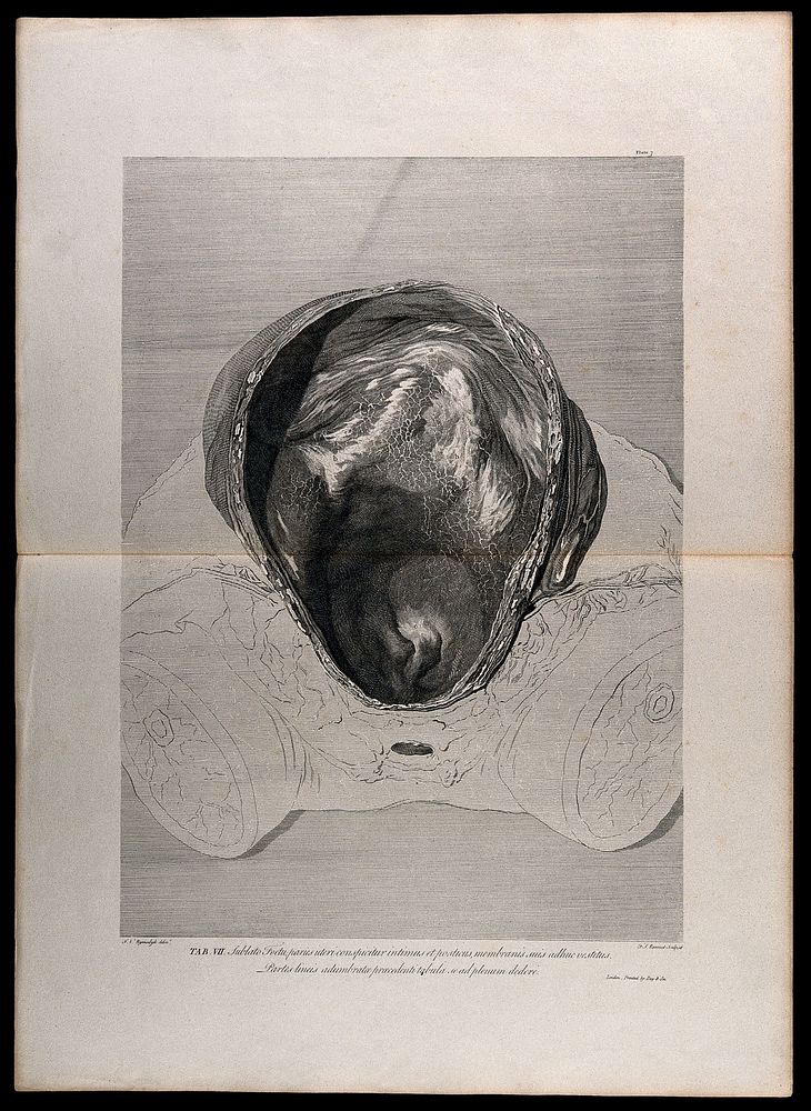 Front view of the cavity of the uterus, after the removal of a foetus: the investing membranes still adhering. Engraving by…