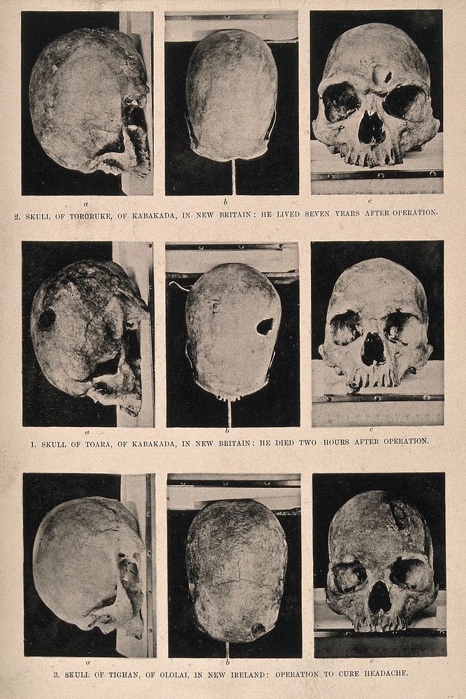 Three trephinated skulls of people who may have suffered from headaches or epilepsy, Papua New Guinea. Halftone.