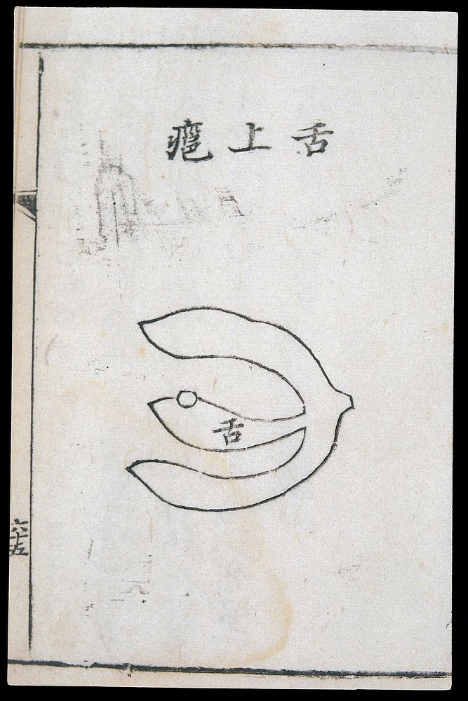 C18 Chinese woodcut: Abscess on the tongu
