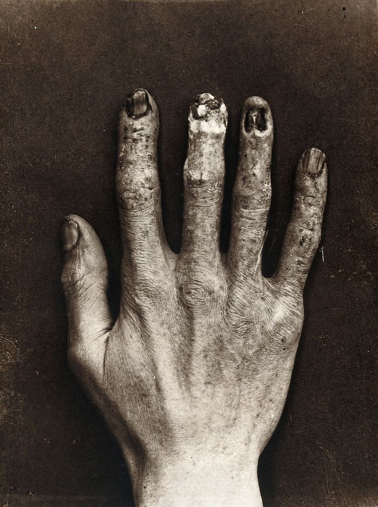 An x-ray technician's hand, mutilated with dermatitis, after habitual work with x-ray apparatus at the Royal London…