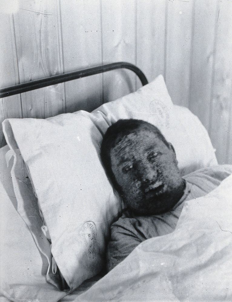 Gloucester smallpox epidemic, 1896: Mr Worgan as a smallpox patient. Photograph by H.C.F., 1896.
