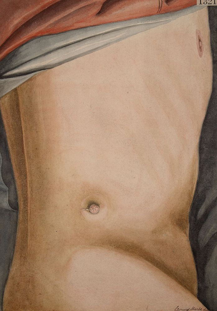 Man with supernumerary nipple above the crest of his right ilium