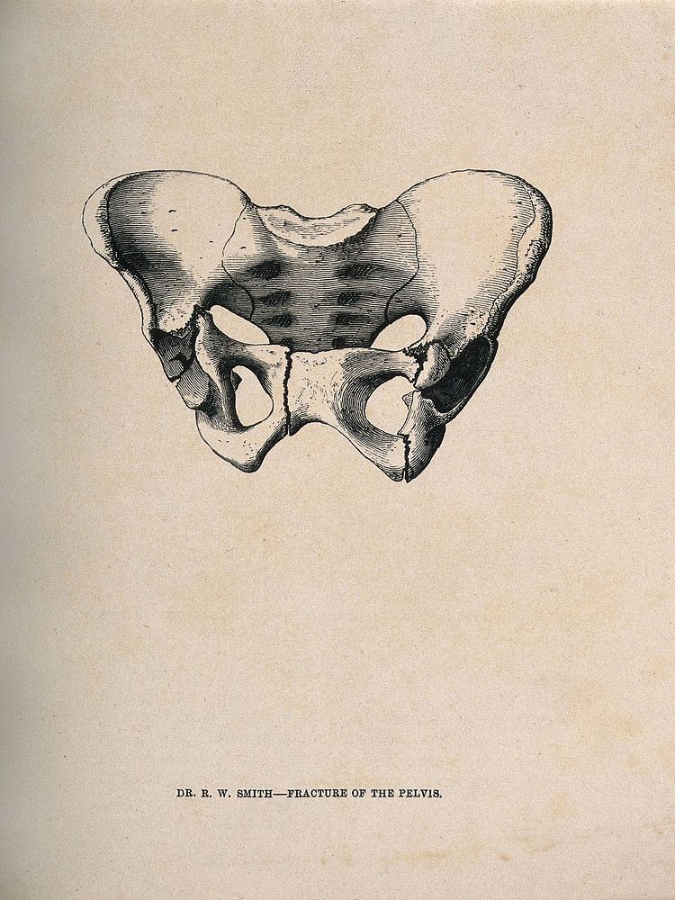 A fractured pelvis bone. Line block print after R.W. Smith, 1862.