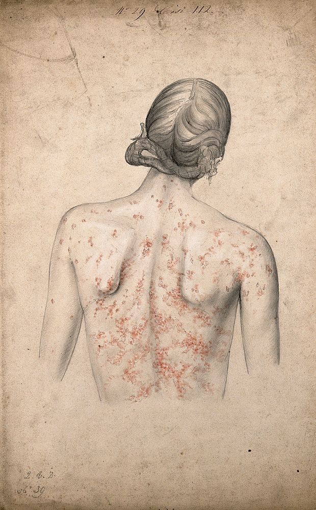 Back of a woman suffering from a rash of sores. Watercolour by C. D'Alton, 1855.