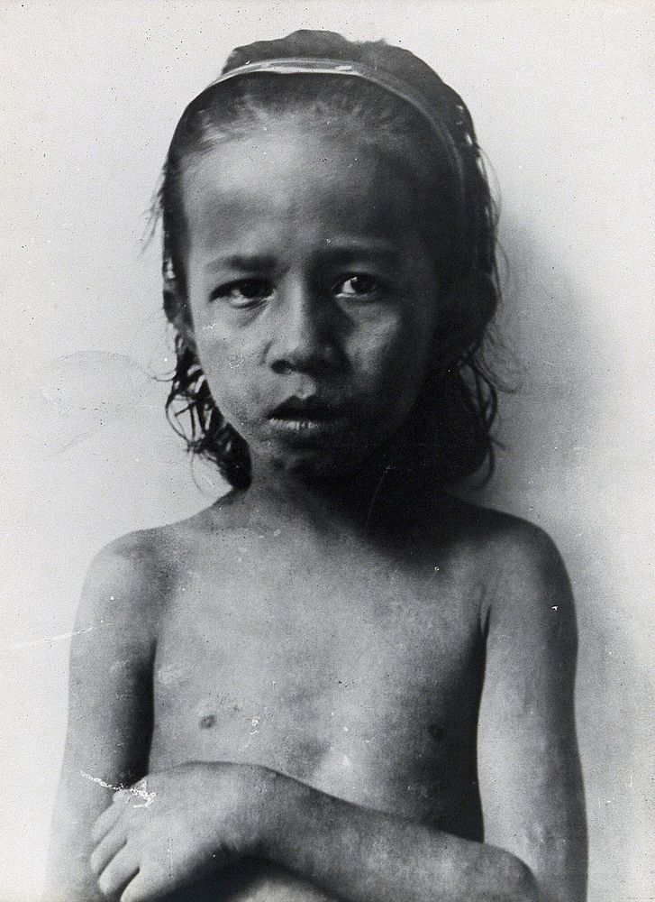 Leprosy : a small bare-chested child. Photograph, 1870/1910.