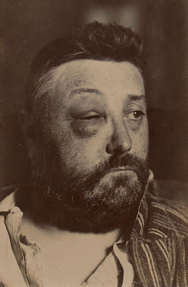 Face of man with partial swelling of the right side of the face