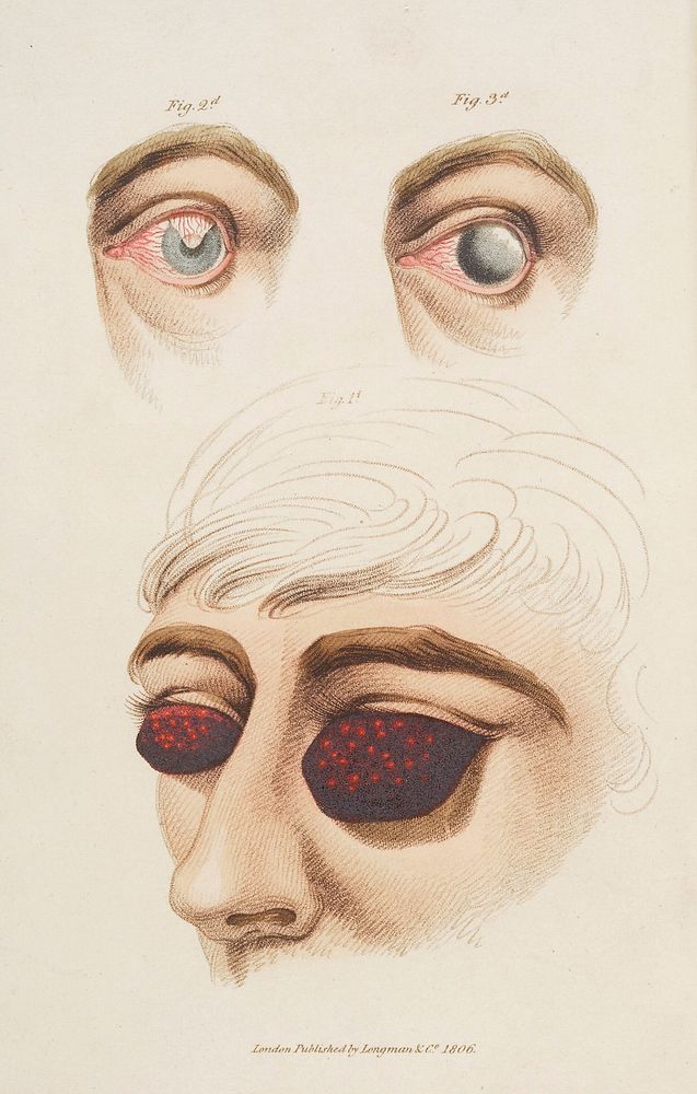 Diagrams of ophthalmia, inflammation of the eye