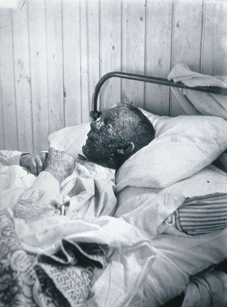 Gloucester smallpox epidemic, 1896: Ephraim Beard, a smallpox patient. Photograph by H.C.F., 1896.