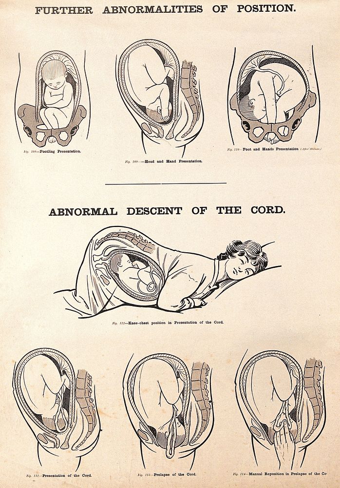 Abnormalities of foetal position and abnormal descent of the cord in childbirth. Lithograph after W. F. Victor Bonney.