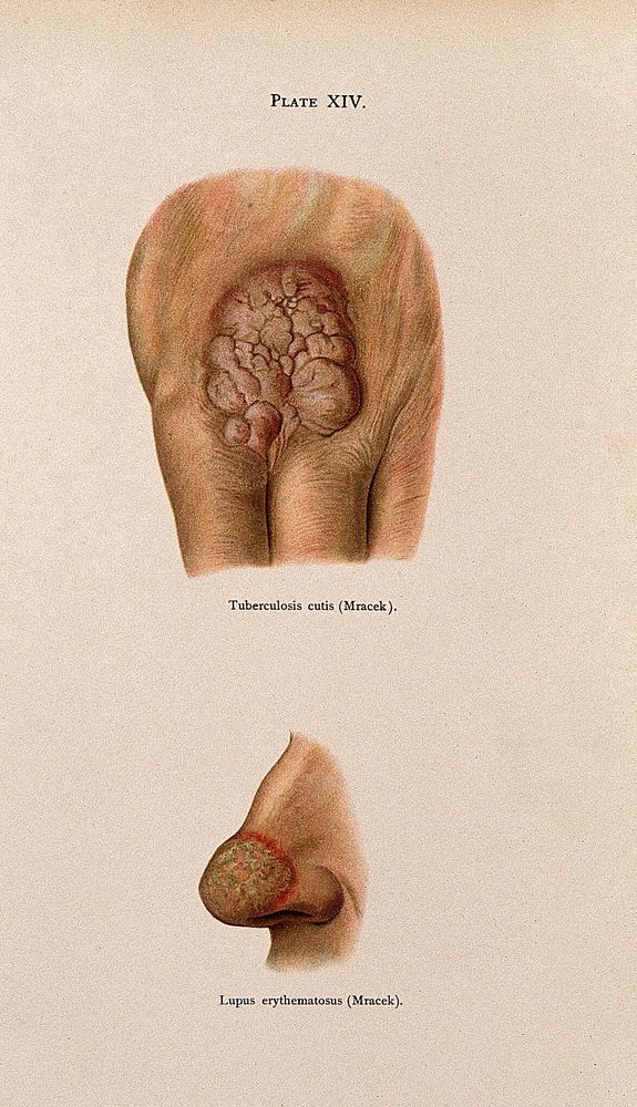 Above, eruption of tuberculosis cutis between the fingers, below, skin on the tip of the nose affected by lupus…