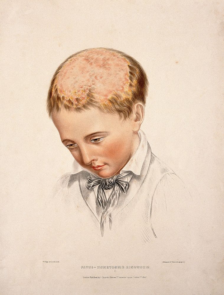 The head of a boy with a skin disease of the scalp. Coloured lithograph by W. Bagg, 1847.