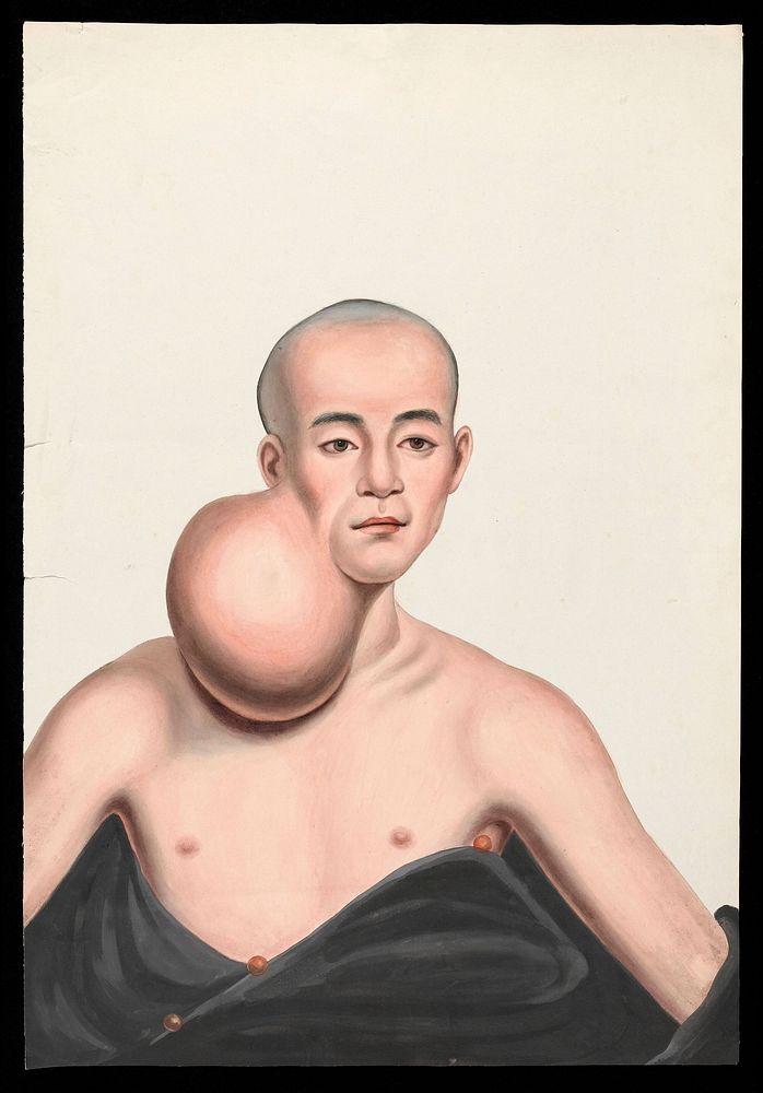 A man (Choo Yihleang), facing front, with a massive spherical tumour on the right side of his neck. Gouache, 18--, after Lam…
